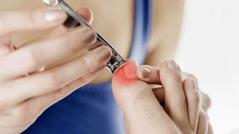 Understanding Ingrown Toenail: Causes & Care